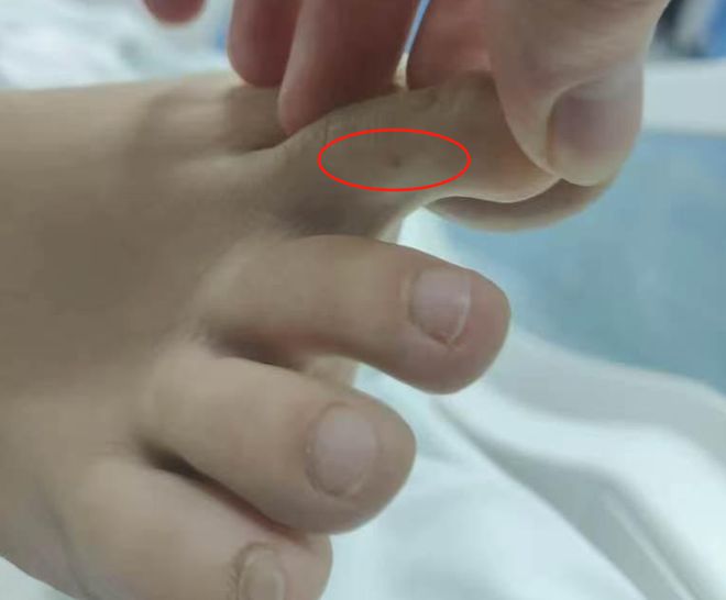 “三亚旅游被不明物咬伤身亡27岁女子”死亡记录：曾诊断为不明生物咬伤(神经毒蛇) 等(图2)